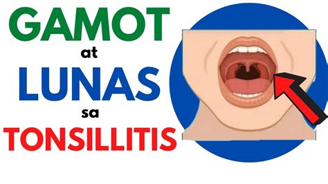 pamamaga ng tonsil|Gamot sa namamagang tonsil .